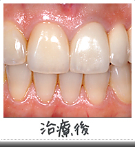 歯列不正改善治療治療後
